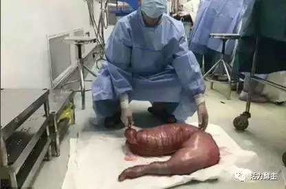上海医生从便秘患者体内取出有13公斤粪便的肠子